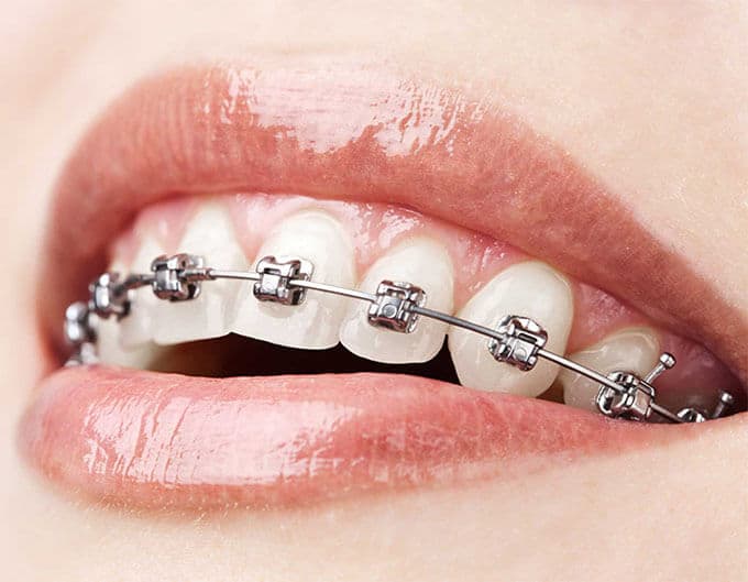 Braces Treatment in Maraimalai Nagar